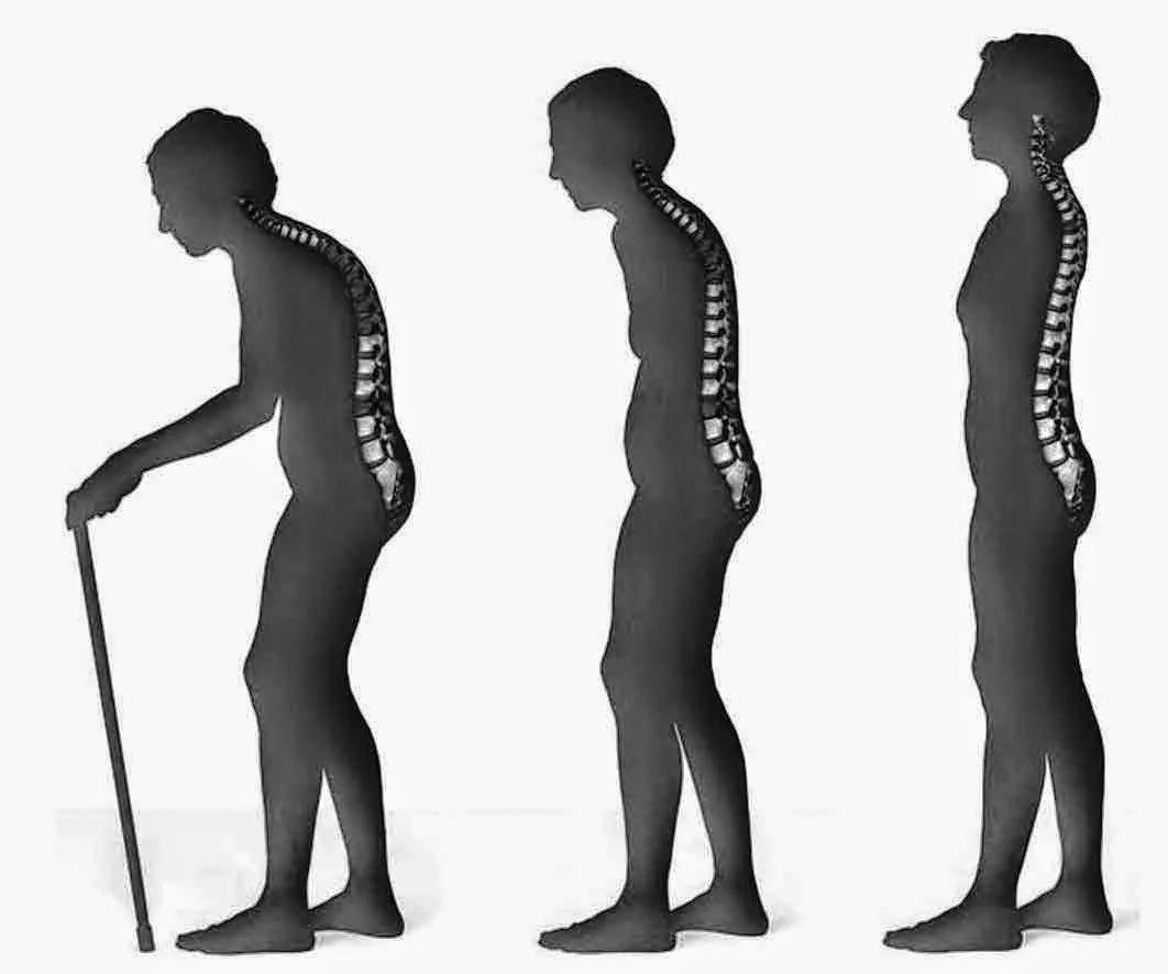 Penanganan Osteoprosis mungkin sulit untuk dilaksanakan. Namun sebenarnya pengobatannya tidaklah begitu merepotkan. Ketika terkena osteoporosis lebih baik pula untuk mencegah dan mengurangi risiko patah tulang yang dapat terjadi akibat jatuh. Baca Juga: Mengenal Gejala dan Pencegahan Osteoporosis Obat dan penanganan osteoporosis sangat ditentukan berdasarkan usia, kepadatan tulang, dan juga faktor resiko keretakan. Mungkin saja sebenarnya [&hellip;]