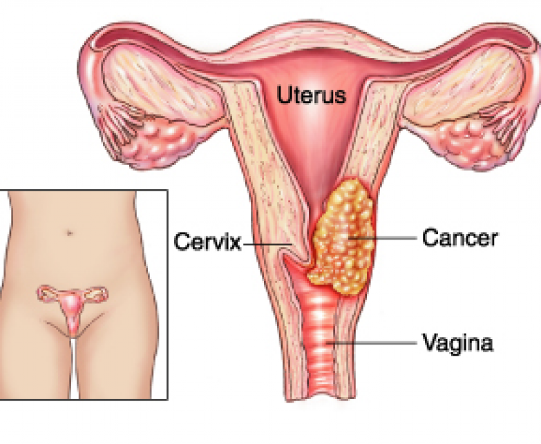 Pap smear sebagai deteksi dini kanker serviks pasti sering terdengar familiar di telinga perempuan. Namun jangan salah, bagi sebagian perempuan Indonesia lainnya, papsmear terdengar asing. Pemeriksaan ini adalah salah satu cara untuk mewaspadai kanker serviks yang menyerang banyak perempuan di Indonesia. Sobat pasti bertanya-tanya seberapa penting papsmear dilakukan?apakah wajib dilakukan? Bagaimana prosedur pemeriksaan pap smear, [&hellip;]