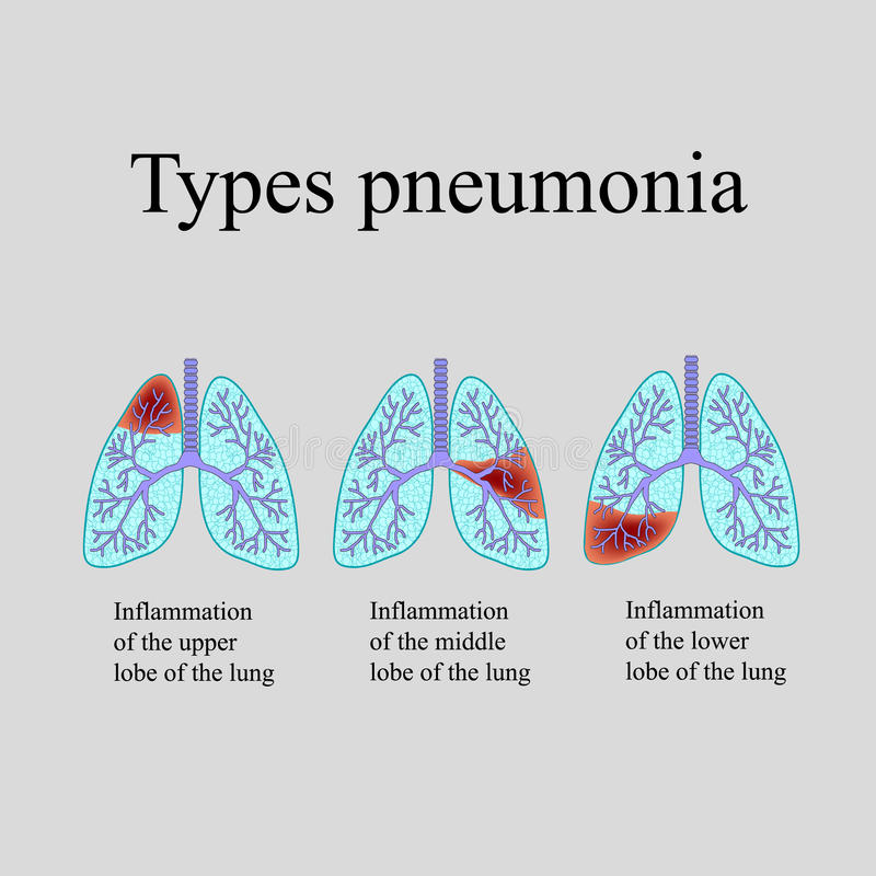 Siapa sih di antara kalian yang sudah mengenal penyakit ini? Atau siapa di antara kalian yang sama sekali belum kenal dengan penyakit paru-paru ini? Radang paru, atau yang biasa kita kenal dengan pneumonia adalah salah satu penyakit berbahaya yang dapat menyebabkan kematian sewaktu-waktu bila penanganannya terlambat. Penyakit berbahaya yang satu ini merupakan suatu infeksi pada [&hellip;]