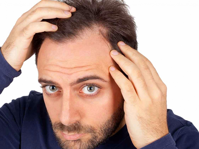 Rambut yang rontok mungkin merupakan hal yang biasa terjadi pada setiap orang. Namun, jika rambut yang rontok tersebut terlalu banyak dan menyebabkan rambut menjadi tipis hingga menuju pada kebotakan,tentunya akan sangat mengganggu penampilan, bukan ? Baca Juga: 8 Cara Mencegah Uban Tumbuh di Usia 30-an Banyak sekali yang menjadi penyebab rambut rontok hingga kebotakan, dari [&hellip;]