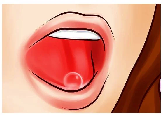 Ketika Sobat secara tidak sengaja terluka pada salah satu anggota badan seperti tangan saat memotong bahan-bahan makanan, yang Sobat lakukan secara spontan adalah mengoleskan luka tersebut dengan air liur. Hal ini Sobat lakukan lantaran Sobat memercayai bahwa mengoleskan air ludah ke luka dapat menyembuhkan luka tersebut, baik luka gores maupun luka bakar. Hal ini tentunya [&hellip;]